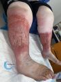 Dermite d'irritation107.jpg