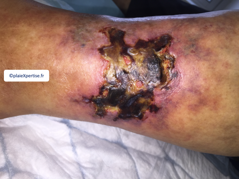 Fichier:Angiodermite typique28.png