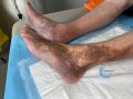 Dermiteocre93.jpg