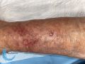Pustules19.jpg