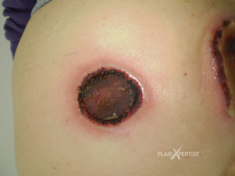 Fichier:Lymphome cutané ulcéré7.png