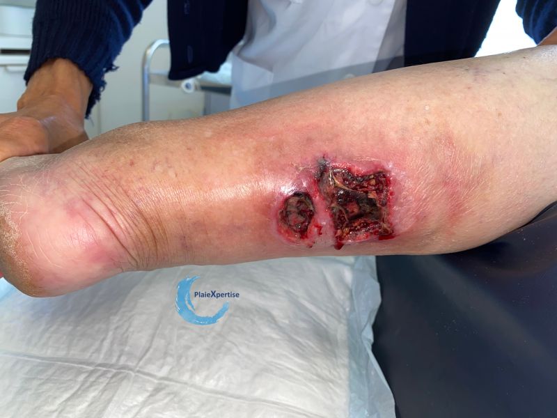 Fichier:Angiodermite typique130.jpg