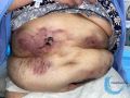 Calciphylaxie10.jpg