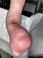 Lymphoedème pied21.png