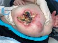 Calciphylaxie16.jpg