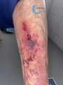 Dermatoporose32.png