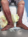 Grosses jambes suintantes12.png