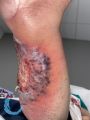 Pyoderma gangrenosum43.jpg