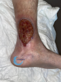 Tissu de granulation inflammatoire29.png