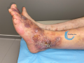 Dermiteocre63.png