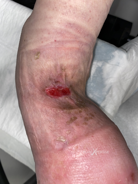 Fichier:Lymphoedème pied22.png