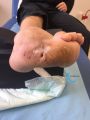 Pied de Charcot49.jpg