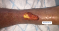 Tendon normal20.png