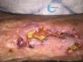 Calcifications43.jpg