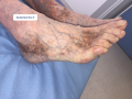 Dermiteocre7.png