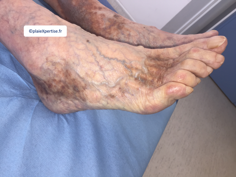 Fichier:Dermiteocre7.png