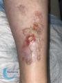 Nécrobiose lipoïdique24.jpg