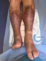 Nécrobiose lipoïdique14.jpg