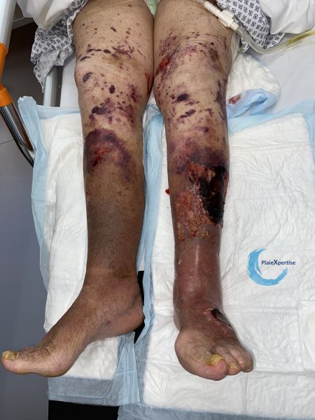Fichier:Dermatoporose62.jpg