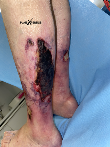 Fichier:Angiodermite typique46.png