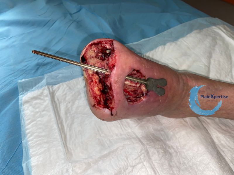 Fichier:Plaies transfixiantes7.jpg