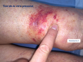 Purpura - Vitro pression1.png