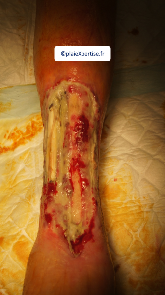 Fichier:Tendon nécrotique humide1.png