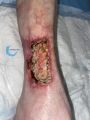 Angiodermite typique105.jpg
