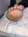 Pied de Charcot48.jpg
