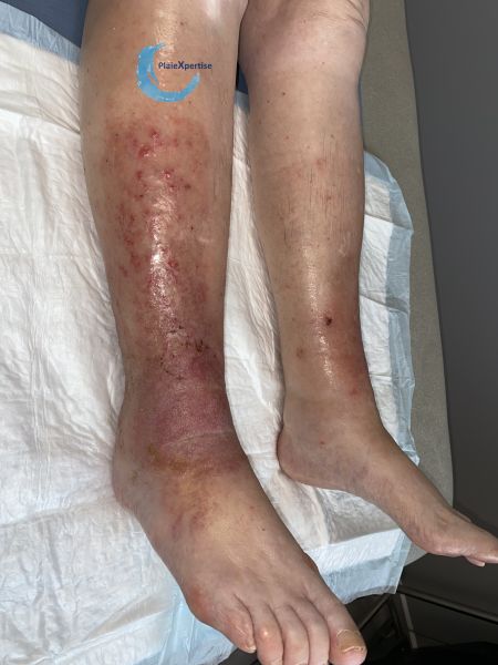 Fichier:Dermite d'irritation173.jpg