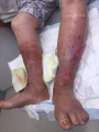 Grosses jambes suintantes14.png