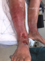 Grosses jambes suintantes15.png