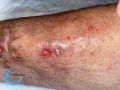 Pustules18.jpg
