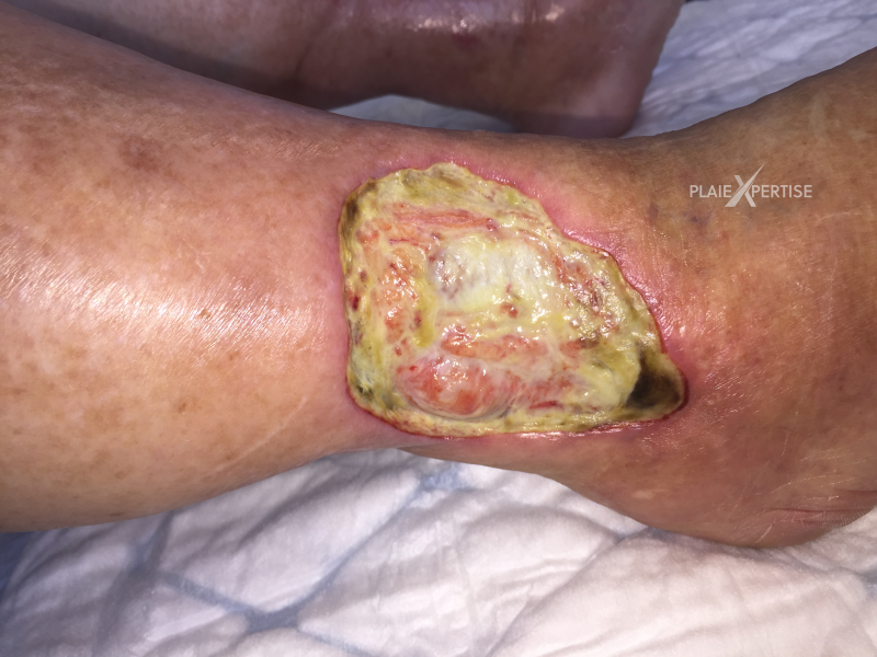 Fichier:Tendon-Voussure15.png