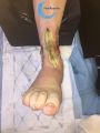 Tendon nécrotique humide66.jpg