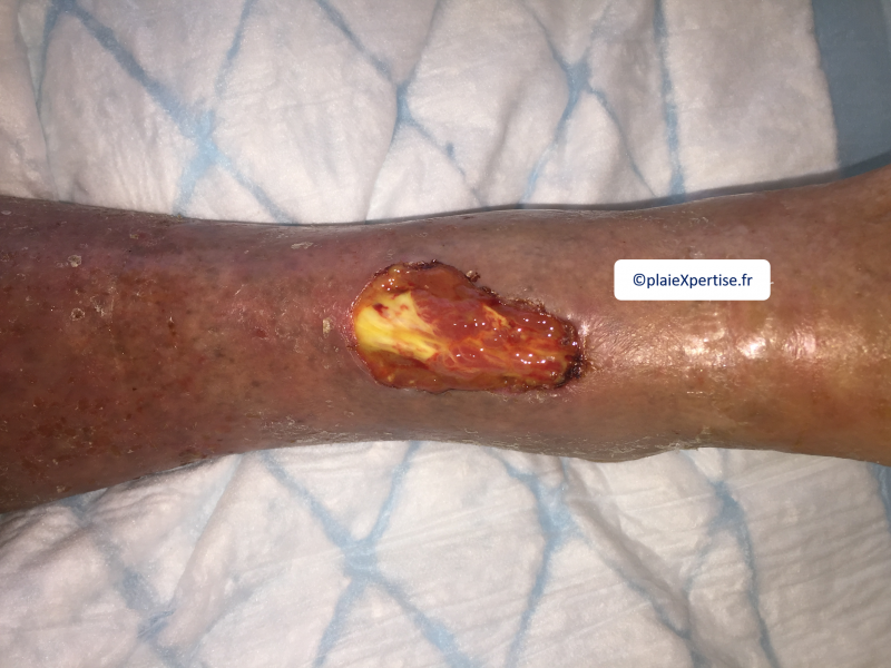 Fichier:Tendon normal22.png