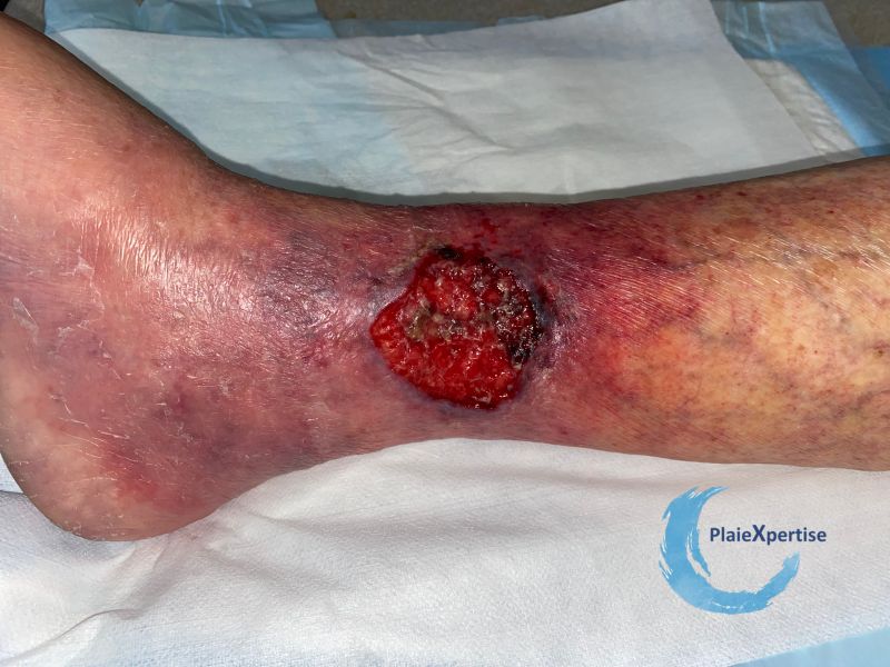 Fichier:Angiodermite typique75.jpg