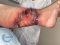 Pyoderma gangrenosum41.jpg