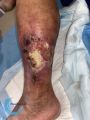 Pyoderma gangrenosum50.jpg