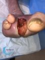 Amputation36.jpg