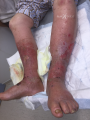 Grosses jambes suintantes13.png