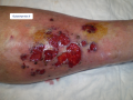 Pyoderma gangrenosum5.png