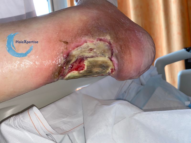 Fichier:Tendon nécrotique humide56.jpg
