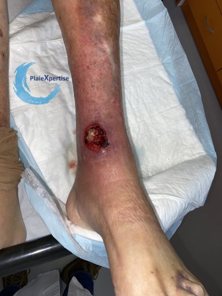 Fichier:Angiodermite typique87.jpg