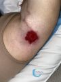 Pyoderma gangrenosum66.jpg