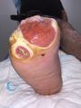 Amputation TM2.jpg