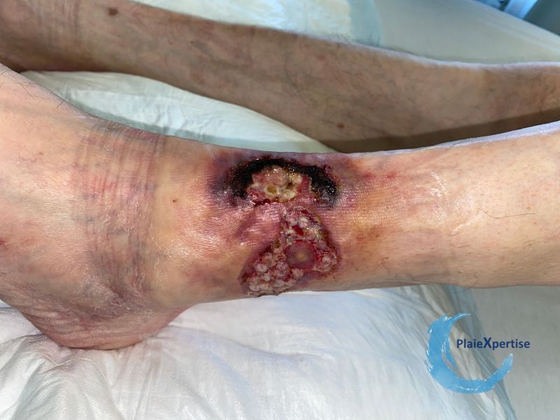 Fichier:Angiodermite typique102.jpg