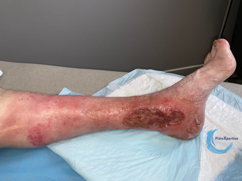 Fichier:Eczéma130.jpg