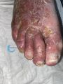 Eczéma161.jpg