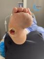 Pied de Charcot33.jpg